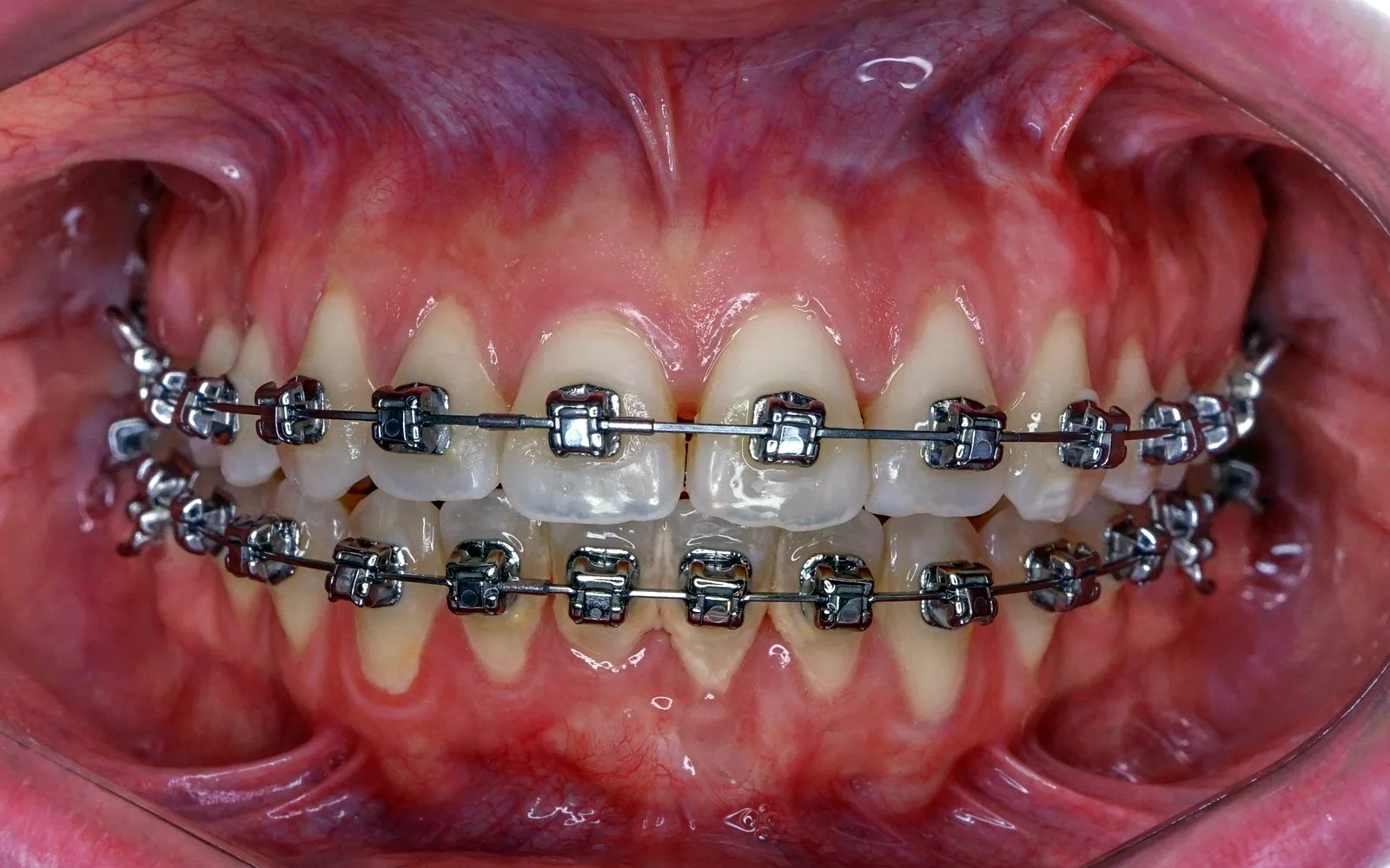 Avance del tratamiento con brackets